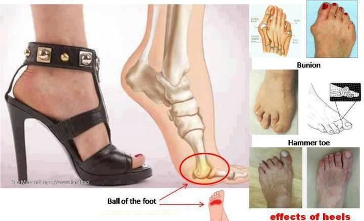 Just For Good Health: 7 Health Effects Of High Heels On Women | FPN