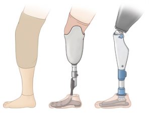 Prosthetic Info | Steinmann Prosthetics & Orthotics